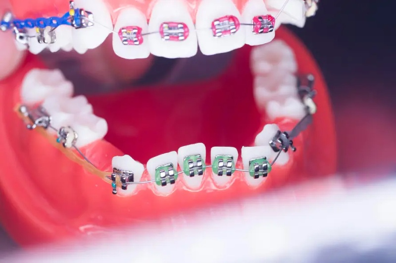 Mất răng niềng được không tùy tình trạng xương hàm