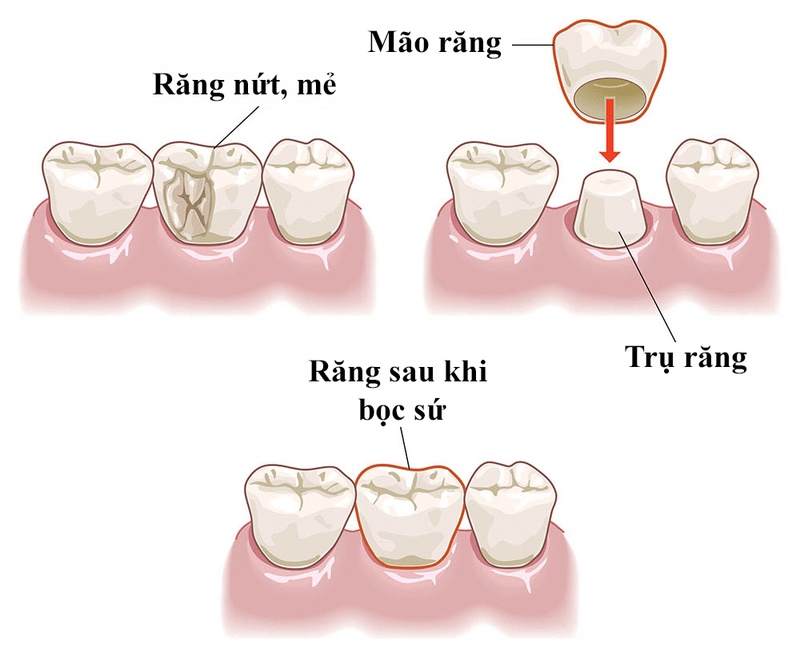 Minh họa quy trình bọc răng sứ