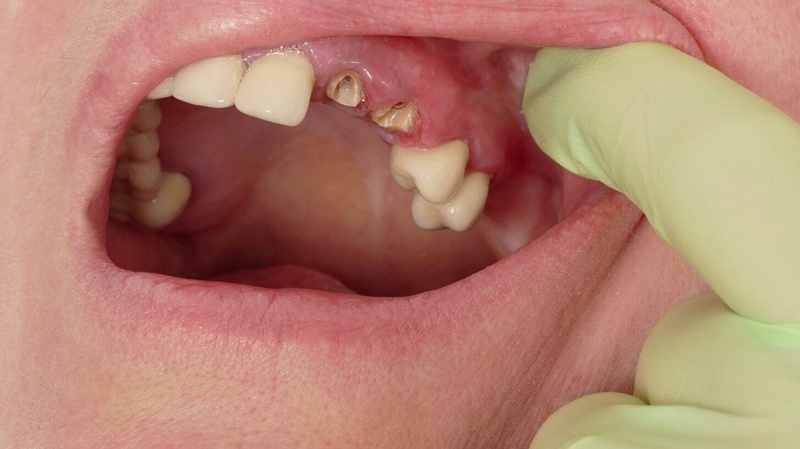 Nguyên nhân gãy răng hàm do nhiều yếu tố