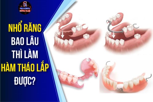 nhổ răng bao lâu thì làm hàm tháo lắp