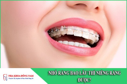 nhổ răng bao lâu thì niềng răng được