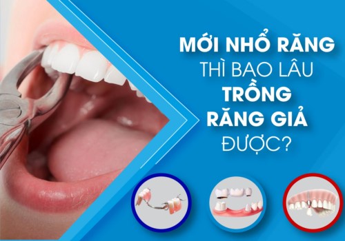 Nhổ răng bao lâu thì trồng răng giả là hợp lý nhất - Nha Khoa Đông Nam®