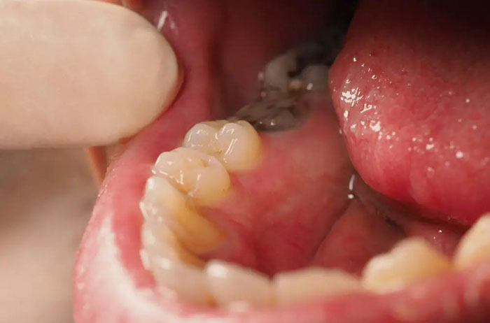 Nhổ răng cho trường hợp răng sâu nghiêm trọng