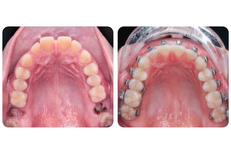 Niềng kéo răng khôn để phục hình răng hàm bị mất