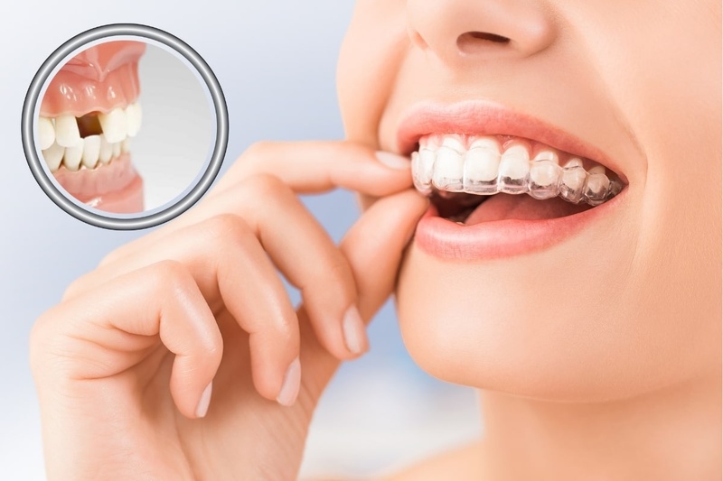 Niềng răng trong suốt vẫn có khả năng xử lý các trường hợp mất răng