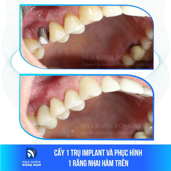 Phục hình mão răng sứ trên Implant và hoàn tất quy trình trồng răng