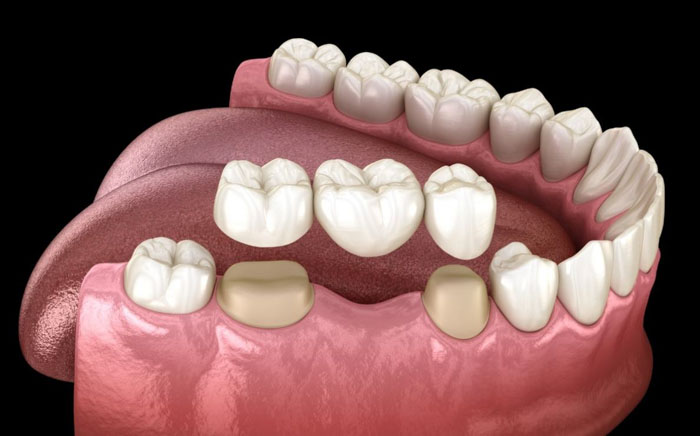 Phương pháp làm răng sứ bắc cầu