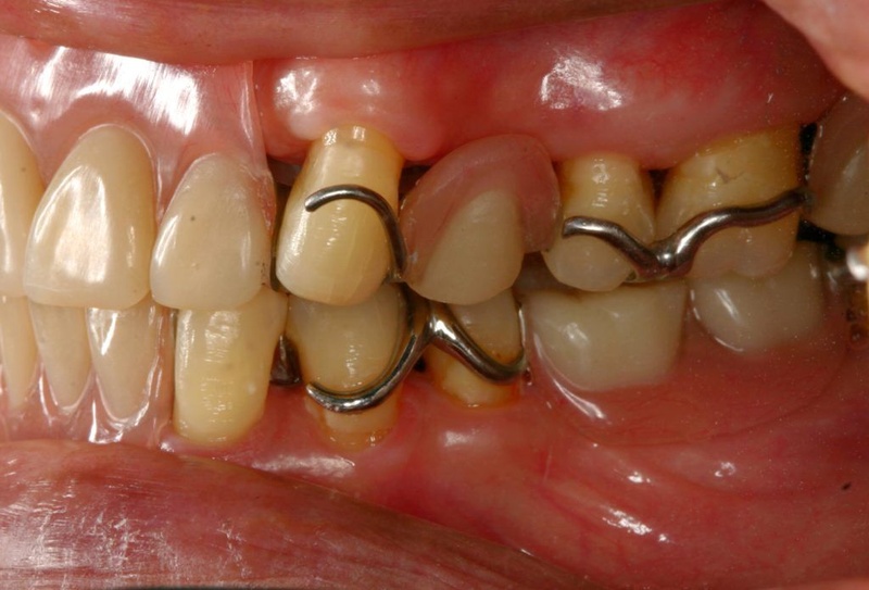 Răng giả tháo lắp là giải pháp phục hình truyền thống