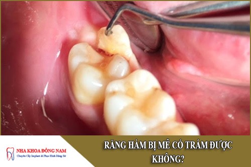 răng hàm bị mẻ có trám được không