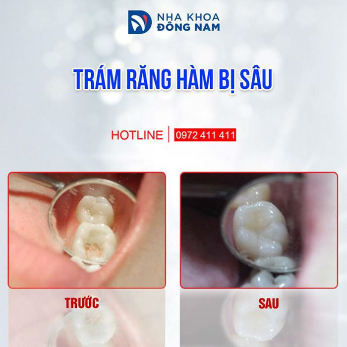 Răng hàm sâu mẻ nhẹ có thể trám răng để khắc phục hiệu quả