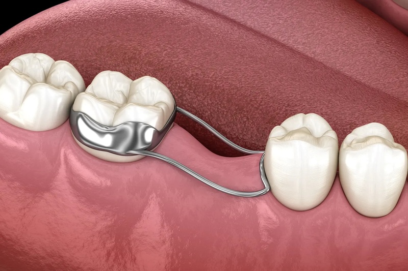 Sử dụng khí cụ tạo khoảng cách để phục hình răng về sau