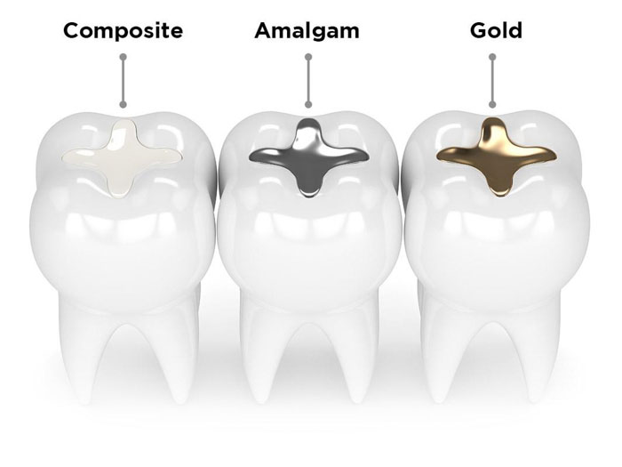 Trám răng Composite được đánh giá an toàn, bền chắc cao