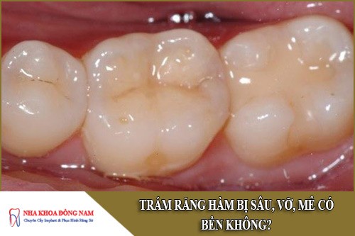 trám răng hàm bị sâu, vỡ, mẻ có bền không