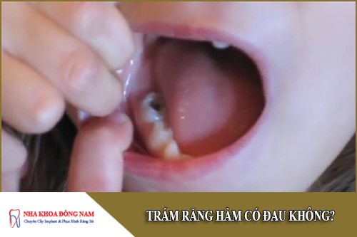 trám răng hàm có đau không