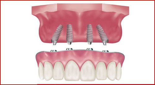 trồng răng implant 4s cho người mất răng toàn hàm