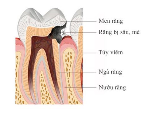 mẻ chân răng