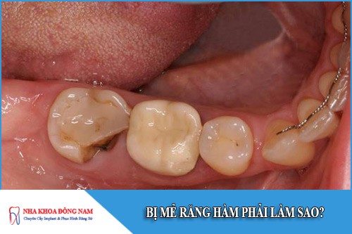 bị mẻ răng hàm phải làm sao