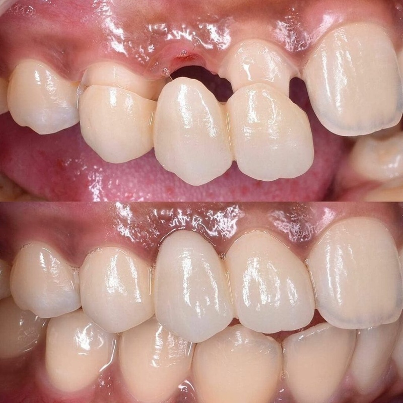 Cầu răng sứ phục hình nhịp cầu răng mất