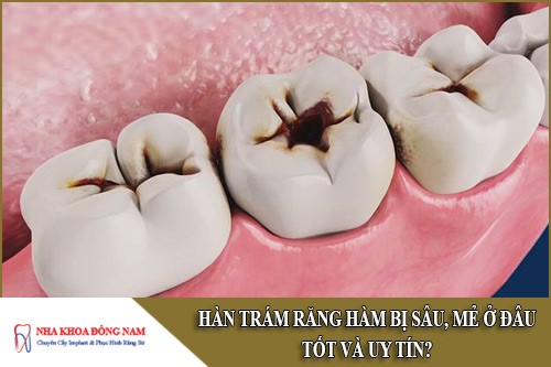 hàn trám răng hàm bị sâu mẻ ở đâu tốt và uy tín