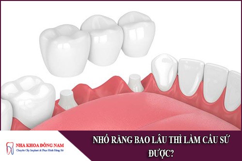 nhổ răng bao lâu thì làm cầu sứ được
