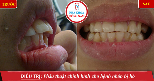 Phẫu thuật chỉnh hình răng cho bệnh nhân bị hô