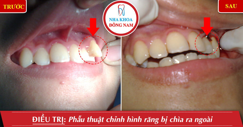 Phẫu thuật chỉnh hình răng bị chìa ra ngoài