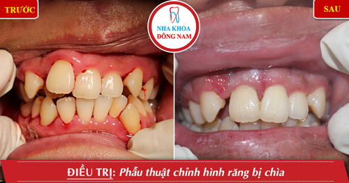 Phẫu thuật chỉnh hình răng bị chìa