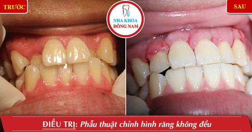 Phẫu thuật chỉnh hình răng không đều
