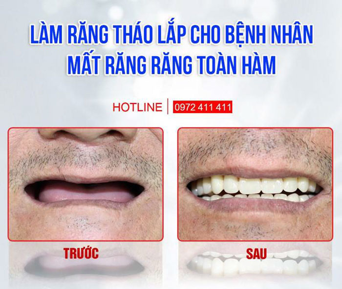 Răng giả tháo lắp có thể áp dụng cho mọi trường hợp mất răng