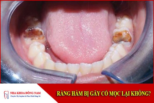 răng hàm bị gãy có mọc lại không