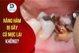 răng hàm bị gãy có mọc lại không