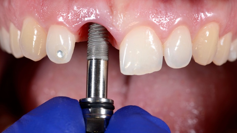 Trồng răng Implant phục hình toàn diện răng mất