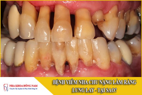 bệnh viêm nha chu nặng làm răng lung lay