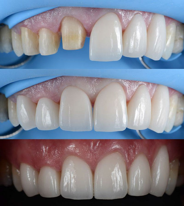 Bọc răng sứ đúng kỹ thuật giúp cải thiện thẩm mỹ và chức năng nhai