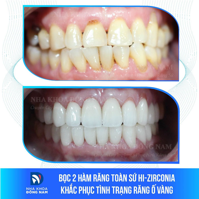 Bọc răng sứ khắc phục tình trạng răng ố vàng, hư tổn