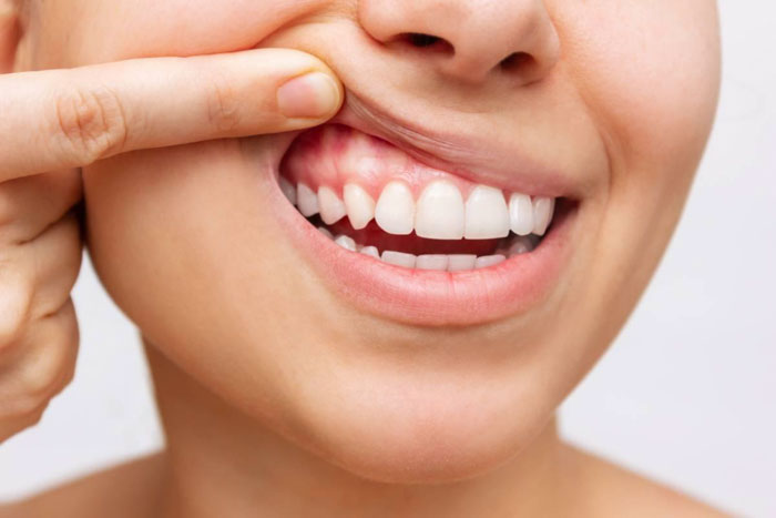 Cảm giác chưa quen và ngứa ở nướu răng