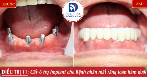 Cấy 6 trụ Implant và phục hình răng sứ hàm dưới