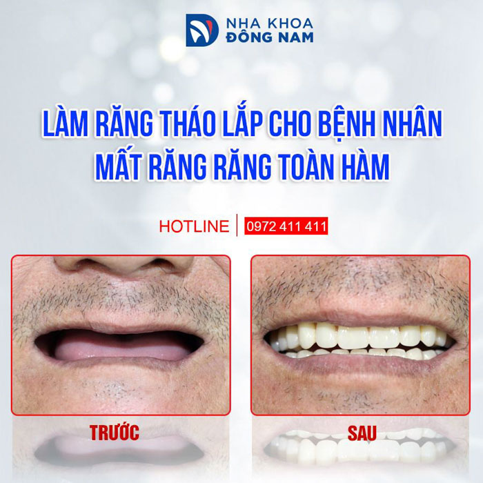 Hàm giả tháo lắp giúp khôi phục thẩm mỹ, ăn nhai tương đối