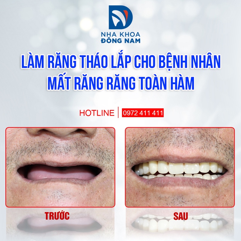 Hàm giả tháo lắp giúp phục hồi ăn nhai ở mức cơ bản