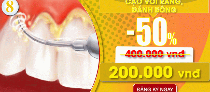 Khuyến mãi cạo vôi răng nhân dịp đại lễ 30/04 và 01/05