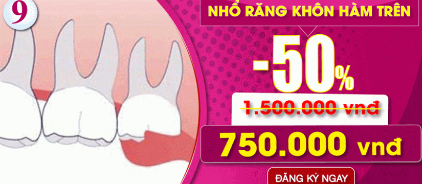 Khuyến mãi nhổ răng khôn hàm trên nhân dịp đại lễ 30/04 và 01/05
