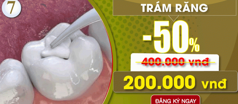 Khuyến mãi trám răng nhân dịp đại lễ 30/04 và 01/05