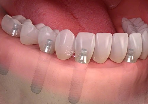 mất hết răng cấy bao nhiêu trụ implant