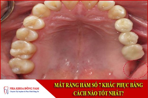 mất răng hàm số 7 khắc phục bằng cách nào tốt nhất