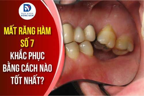 mất răng hàm số 7 khắc phục bằng cách nào tốt nhất