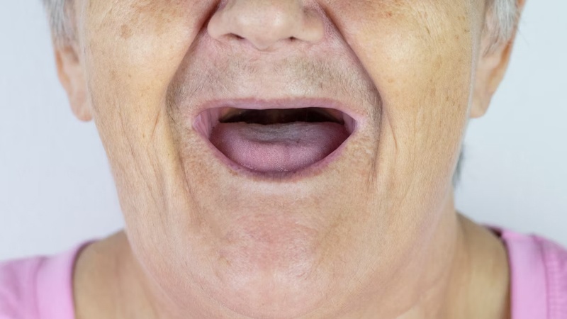 Mất răng toàn hàm lâu ngày gây ra nhiều hậu quả nghiêm trọng