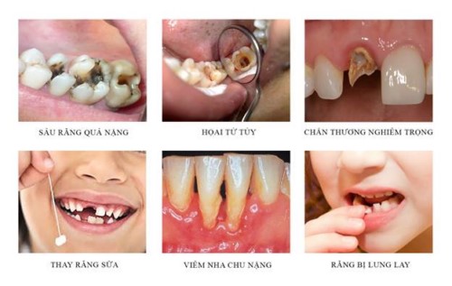 trường hợp cần nhổ răng hàm