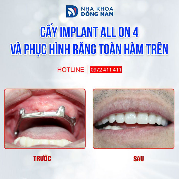 Phục hình răng mất nguyên hàm bằng giải pháp Implant All On 4