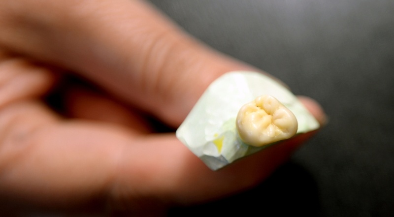 Răng sứ bị vỡ và bong ra có nguy cơ nuốt phải