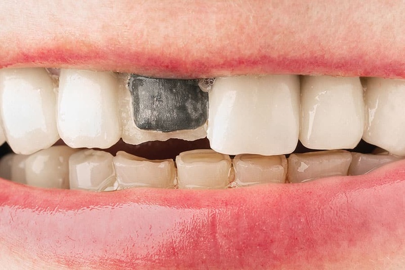 Răng sứ kim loại tiềm ẩn nguy cơ đen viền nướu